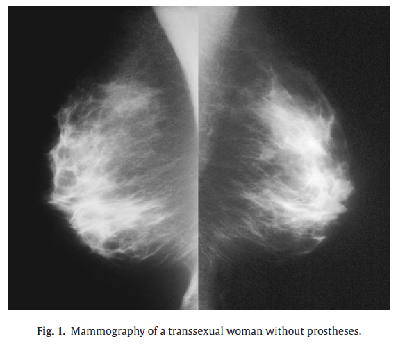 breast changes with hormones transgender photos